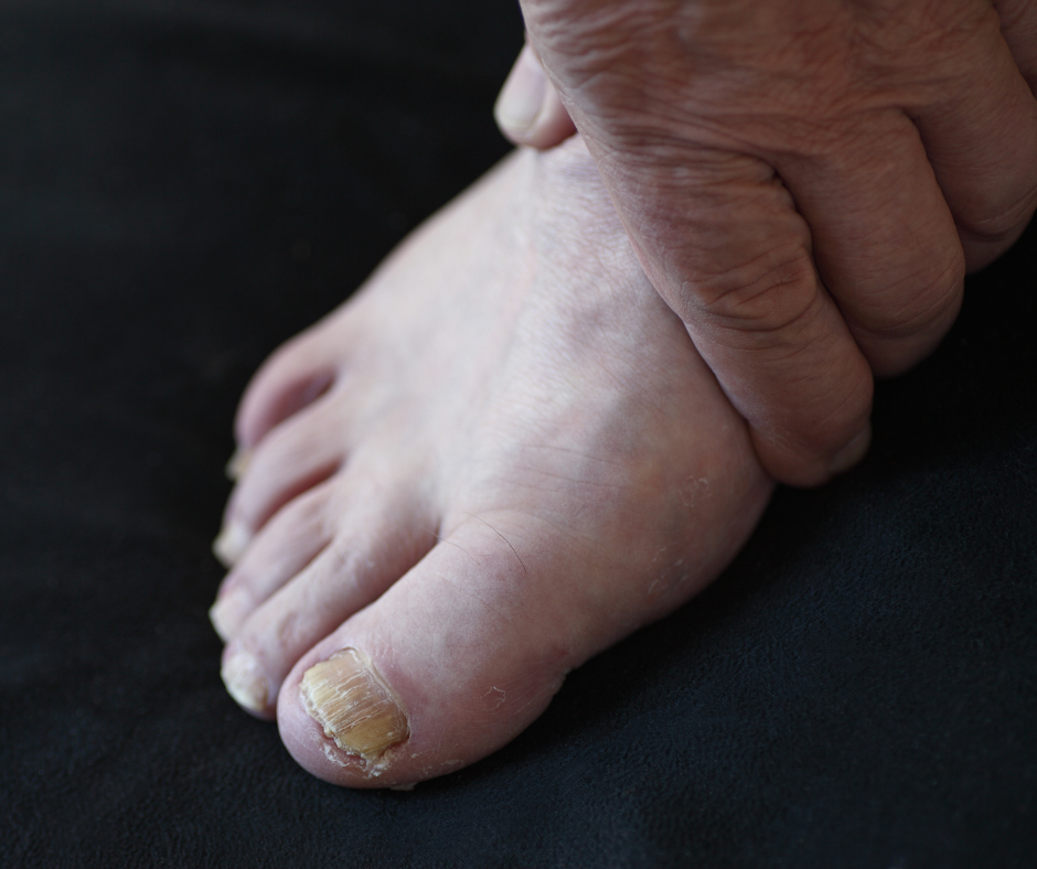yellow toenails